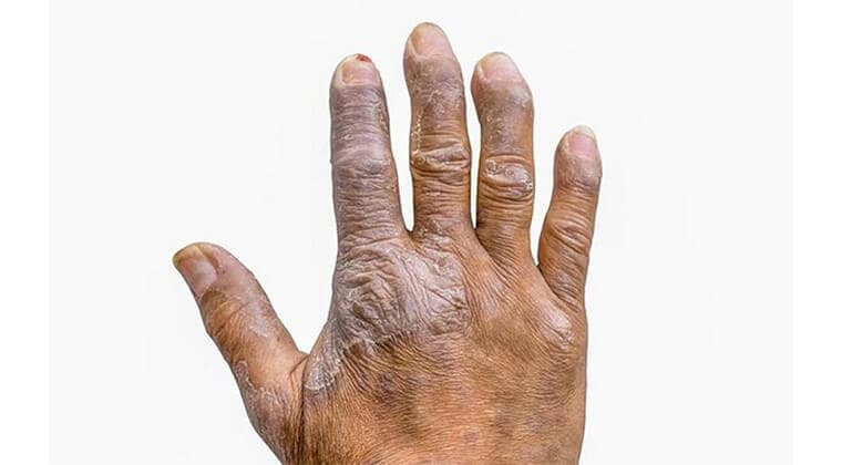 Artritis psoriásica