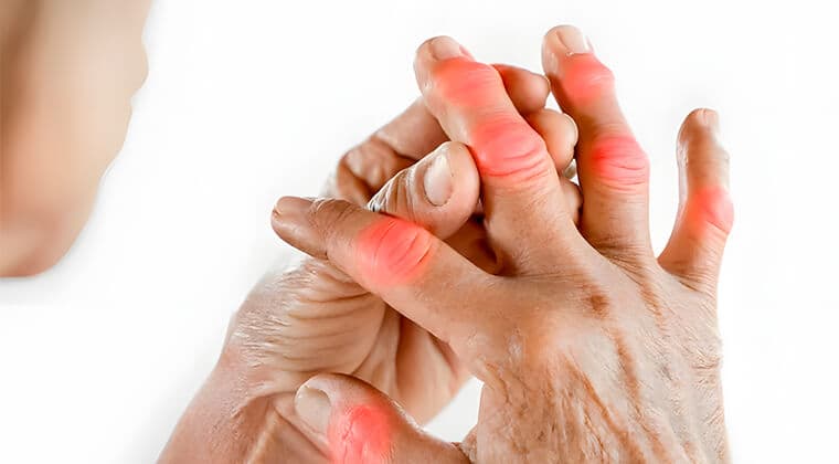 Artritis reumatoide