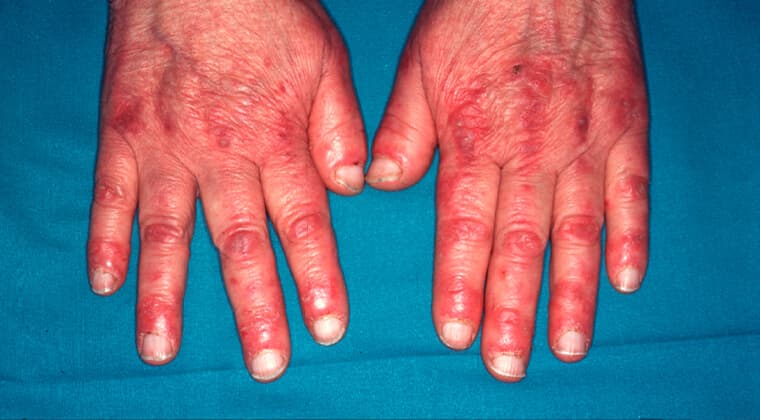 Dermatomiositis