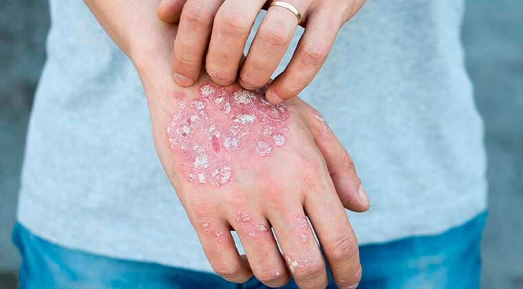 Esclerodermia