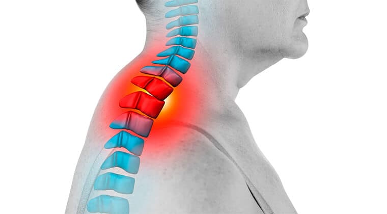 Espondilitis anquilosante