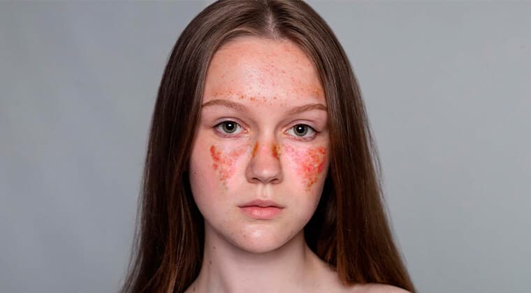 Lupus eritematoso sistémico