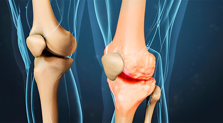 Osteoartritis