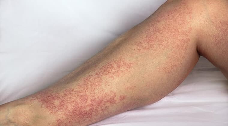 Vasculitis