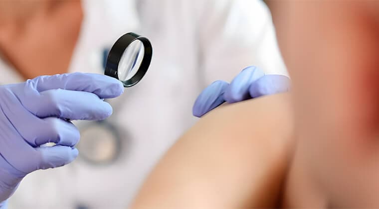 Tratamiento del lupus eritematoso sistémico