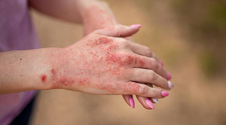 Erupciones cutáneas asociadas a dolor articular
